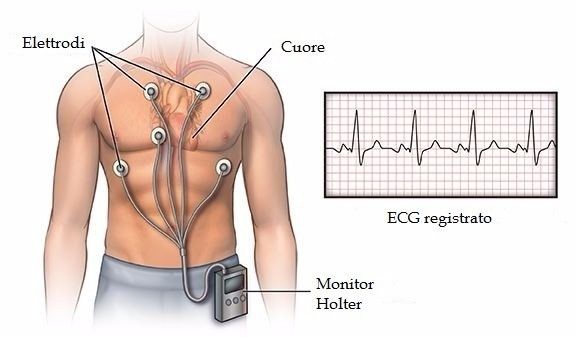 HOLTER CARDIACO